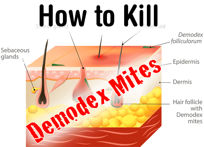 Disease description - DemodexDemodex