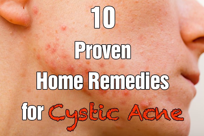 Can Cystic Acne Last For Years