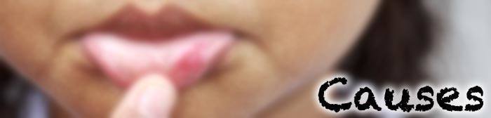 canker sore causes