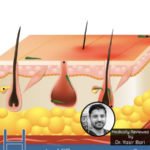 How to Kill Demodex Mites