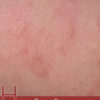 Home Remedies for Rashes
