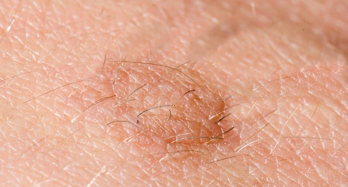 skin tag