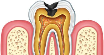 cavity