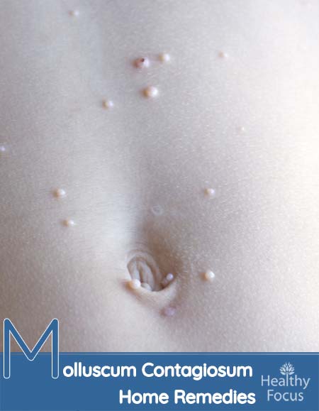 Molluscum Contagiosum Home Remedies