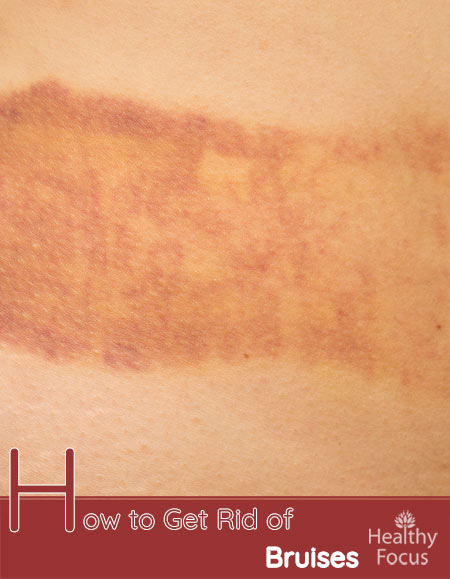 How to Get Rid of Bruises-14 ways