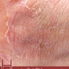 How to Get Rid of Eczema