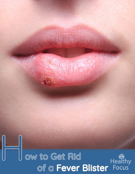 How to Get Rid of a Fever Blister