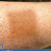 Iodine Patch Test