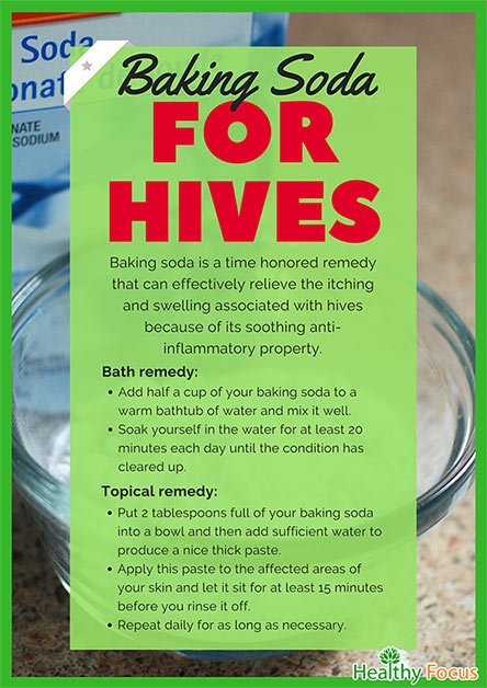 10 Proven Home Remedies For Hives Healthy Focus 2469