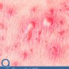 9 Essential Oils for Shingles