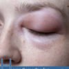 Home Remedies for Angioedema