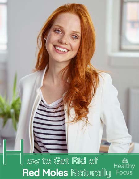 how-to-get-rid-of-red-moles-naturally-healthy-focus