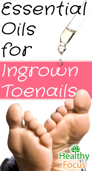 How to Get Rid of an Ingrown Toenail 3 mig Use these Essential Oils Ingrown Toenails