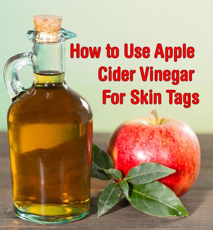 How to Use Apple Cider Vinegar For Skin Tags 1 hdr-How-to-Use-Apple-Cider-Vinegar-For-Skin-Tags