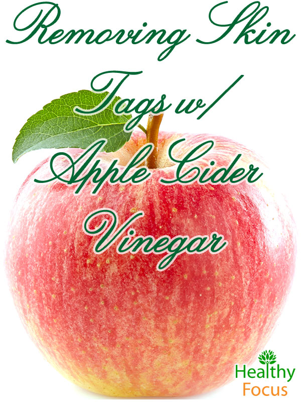 How to Use Apple Cider Vinegar For Skin Tags 3 mig-10-Natural--Remedies-f-Perioral-Dermatitis
