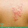 Top 10 Shingles natural treatments