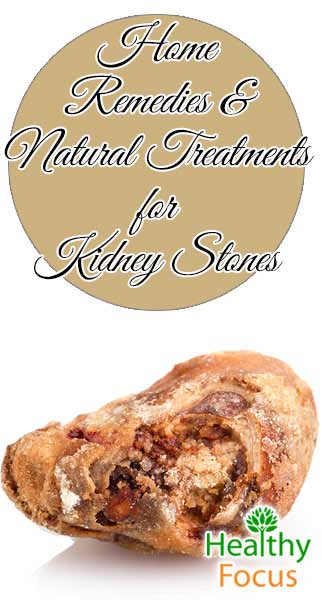 12 Kidney Stones Natural Treatments 14 mig2 Home Remedies Natural Treatments for Kidney Stones
