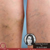 9 Proven Essential Oils for Varicose Veins