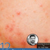 12 Proven Home Remedies for Cystic Acne