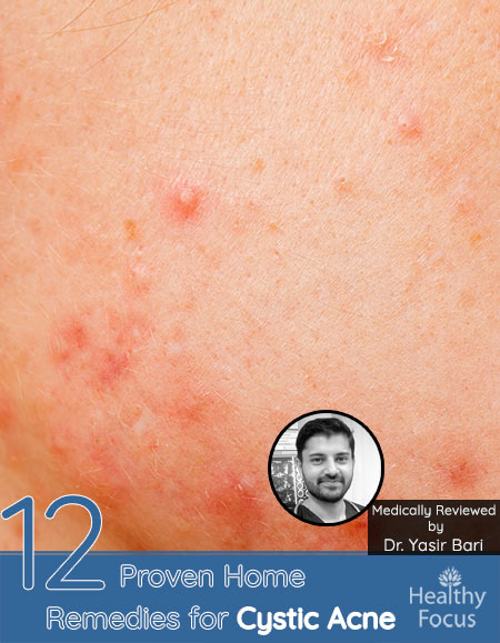 12 Proven Home Remedies for Cystic Acne 1 12 Proven Home Remedies for Cystic Acne