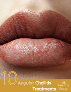 Top 10 Angular Cheilitis Treatments - Healthy Focus