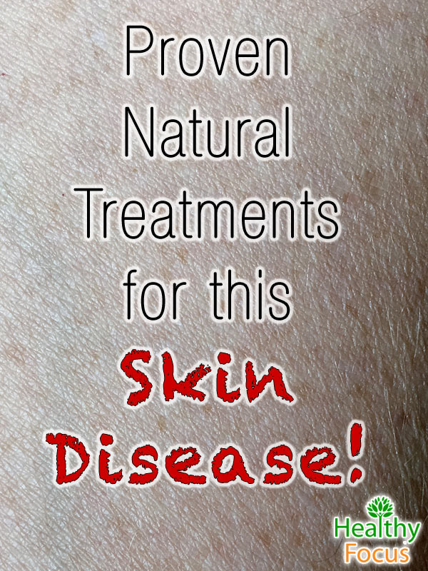 10 Proven Natural Treatments for Cellulitis 2 mig-Proven--Natural--Treatments--for-this--Skin-Disease