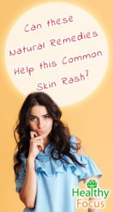 10 Natural Remedies For Perioral Dermatitis Healthy Focus 10 Natural Remedies For Perioral Dermatitis Healthy Focus