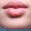 How to Get Rid of a Fever Blister