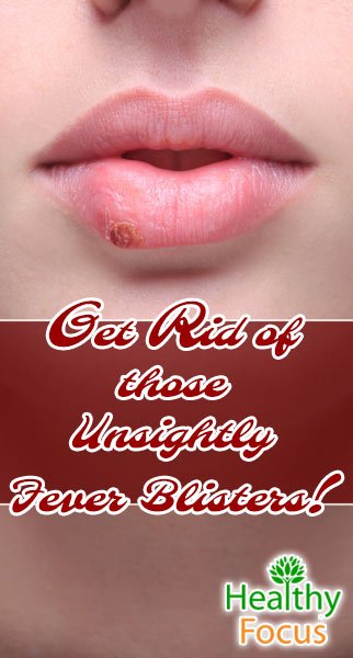 How to Get Rid of a Fever Blister 3 mig2 Get Rid of those Unsightly Fever Blisters