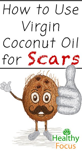 How To Get Rid of Keloids-9 Ways 5 mig2 How to Use Virgin Coconut Oil for Scars