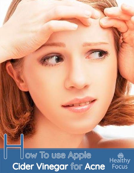 How To use Apple Cider Vinegar for Acne 1 How To use Apple Cider Vinegar for Acne