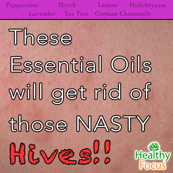 7 Proven Essential Oils for Hives 2 mig-These--Essential-Oils-get-rid-of-those-NASTY-Hives