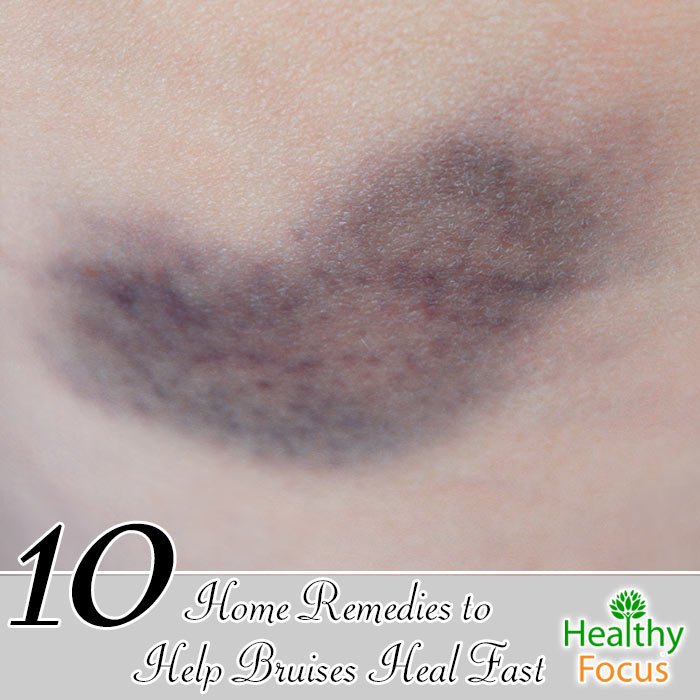 10 Home Remedies to Help Bruises Heal Fast 1 hdr 10 Home Remedies to Help Bruises Heal Fast